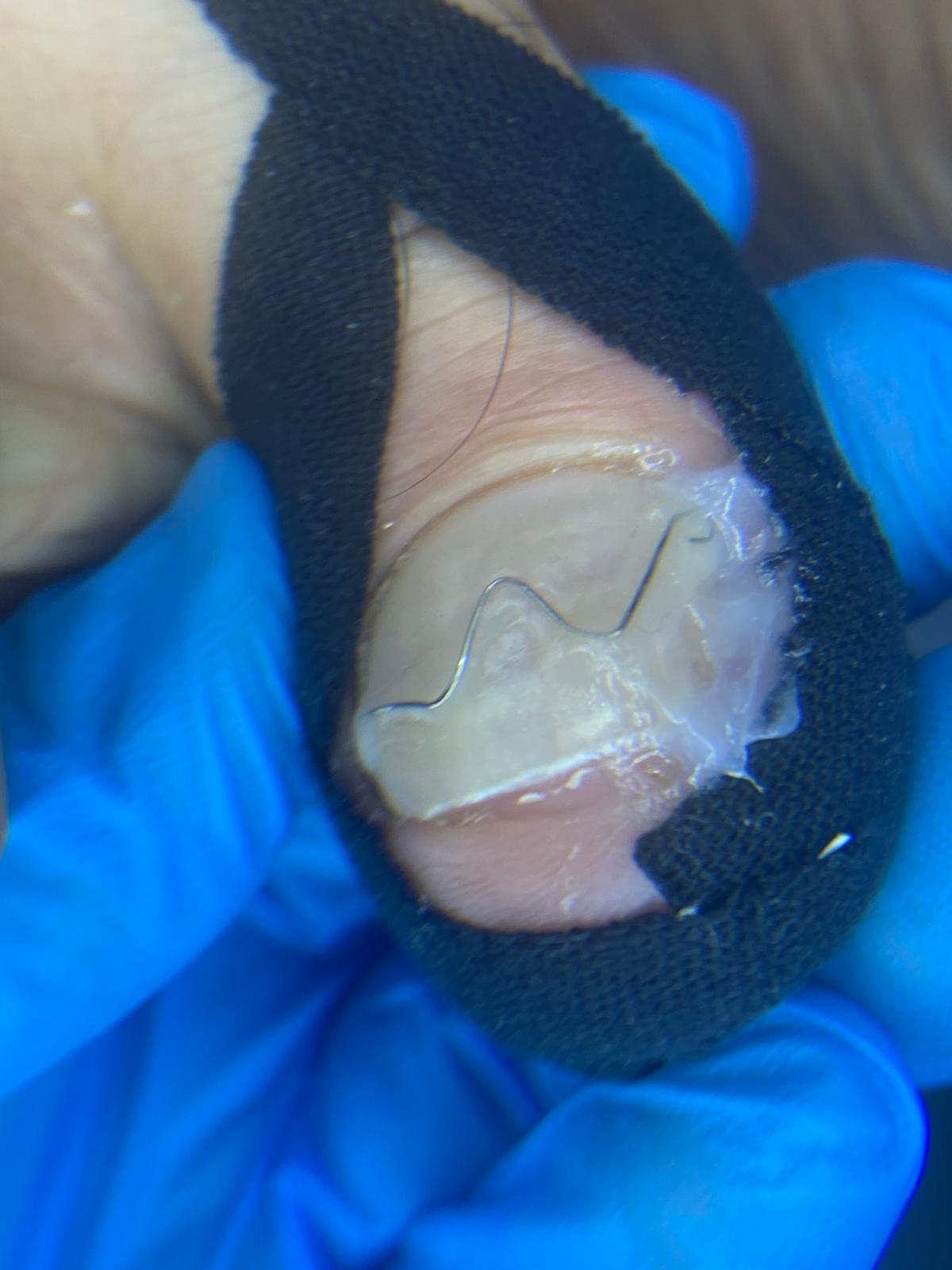 BRACE M (TEL YÖNTEMİ)