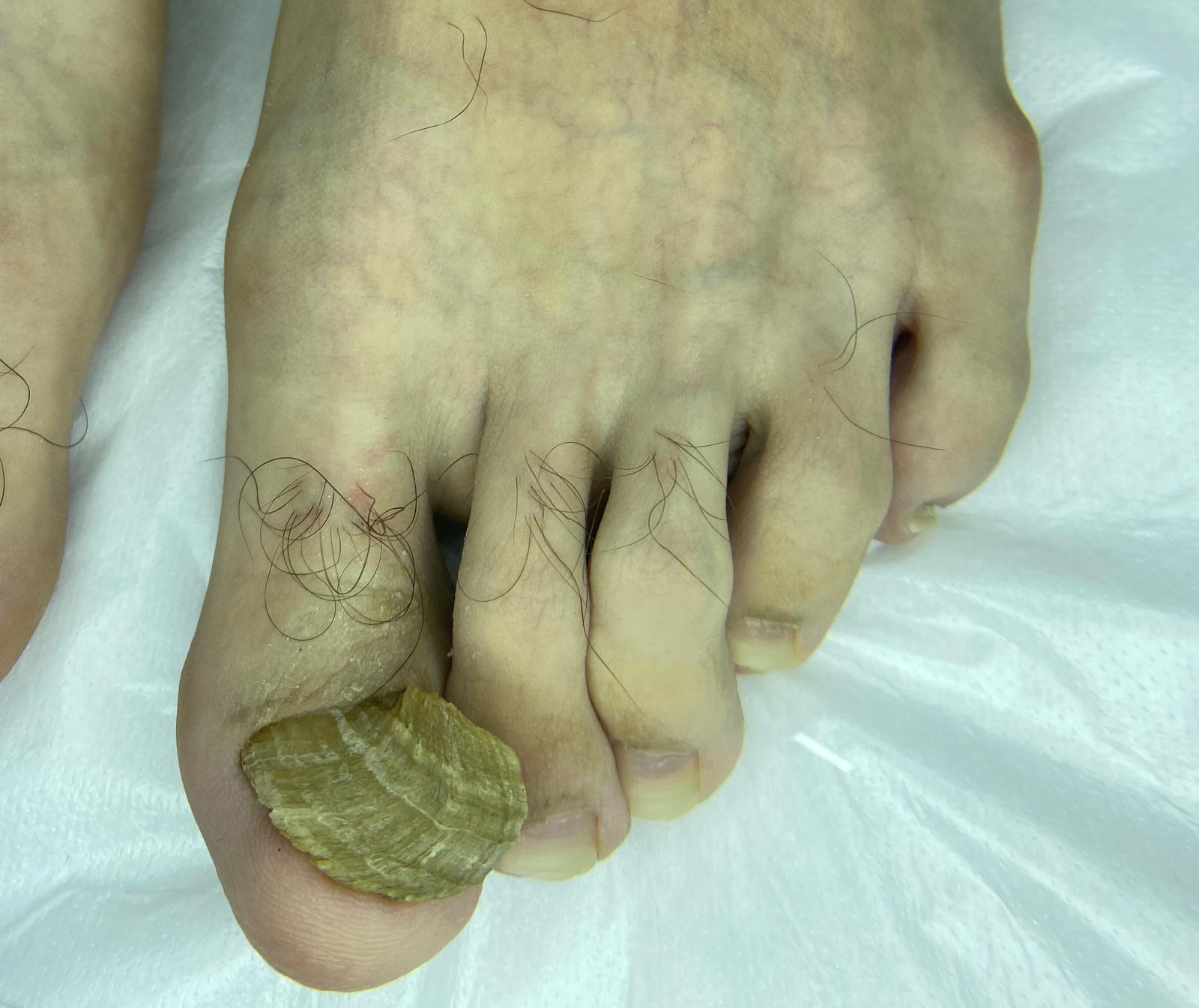 ONİKOGRİFOZ ( KALINLAŞMIŞ TIRNAK BAKIMI )