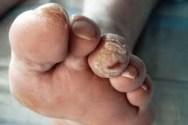 DİYABETİK AYAK BAKIMI